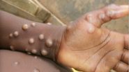 Monkeypox: दुनिया में तेजी से पैर पसार रहा है मंकीपॉक्स, कई देशों में फैला संक्रमण, जानें कारण और लक्षण